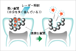 レーザー治療説明